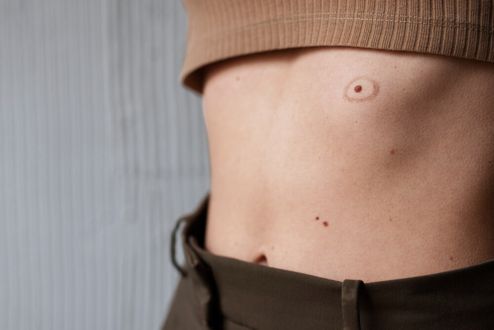moles evaluation at FDL Dermatology in Arlington VA