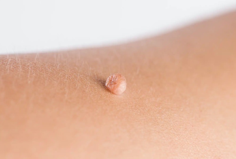 Skin Tags FDL Dermatology in Arlington VA