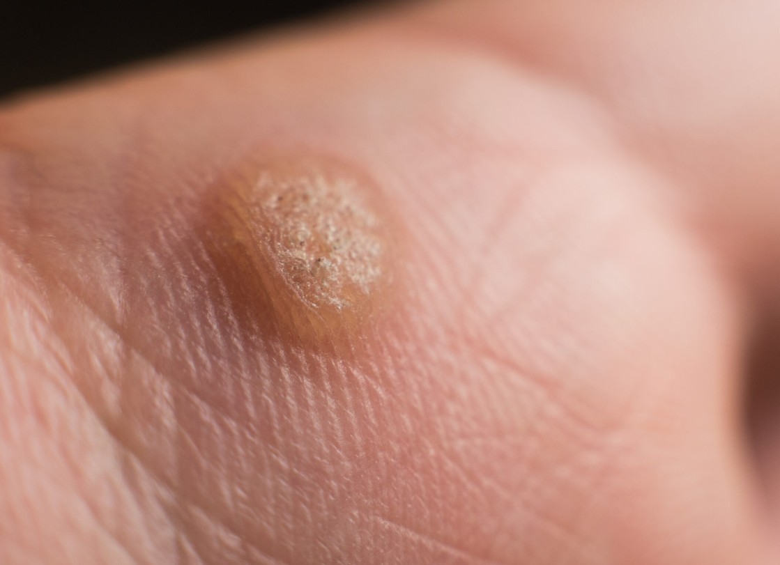 moles evaluation at FDL Dermatology in Arlington VA