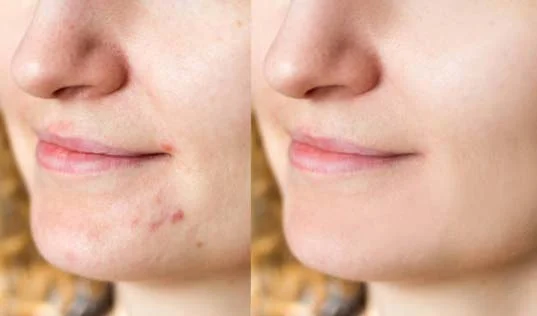 acne-treatment-ba1 FDL Dermatology