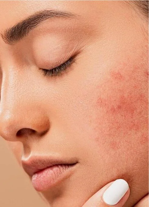 cosmetic-treatment-botox FDL Dermatology in Arlington