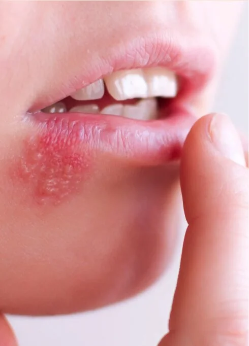 cosmetic-treatment-botox FDL Dermatology in Arlington