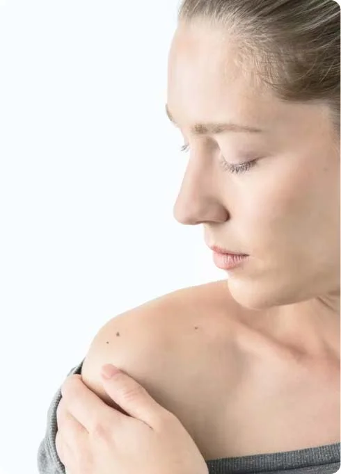 moles evaluation at FDL Dermatology in Arlington VA